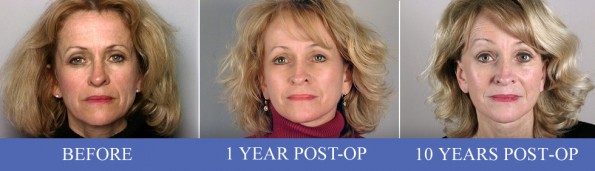 Front view of of female facelift patient before, 1 year after, and 10 years after surgery