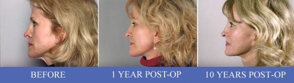 Profile of female facelift patient before, 1 year after, and 10 years after surgery
