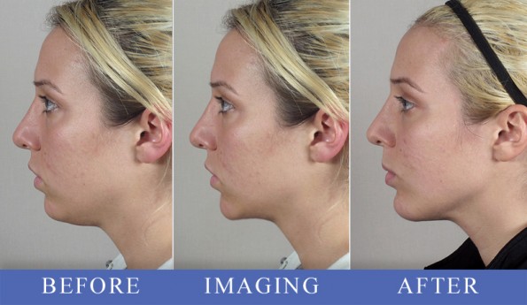 Young female\'s profile before, simulated with imaging, and after rhinoplasty