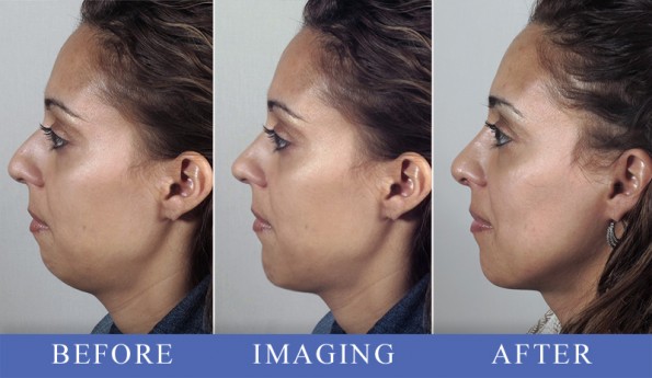 Woman\'s profile before, simulated with imaging, and after rhinoplasty