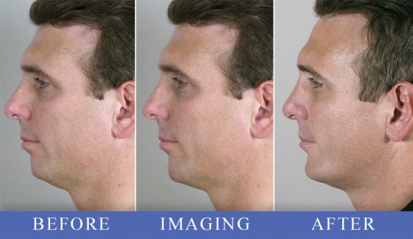 Man\'s profile before, simulated with imaging, and after rhinoplasty