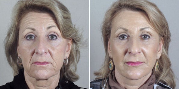 Front view of older woman before and after facelift