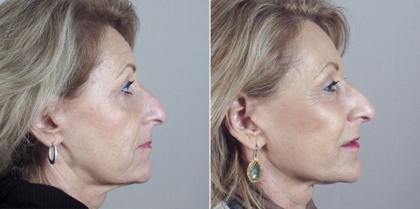 Profile of older woman before and after facelift