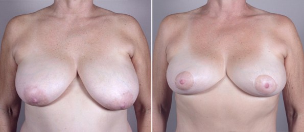 Front view of woman\'s chest before and after mommy makeover surgery