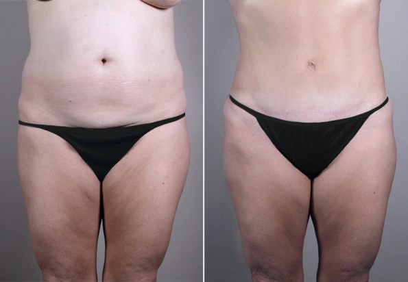 Front view of female patient before and after tummy tuck