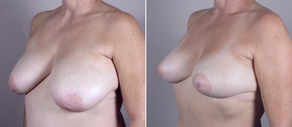 Side view of woman\'s chest before and after mommy makeover surgery