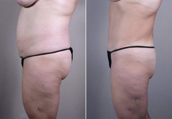 Side view of female patient before and after tummy tuck