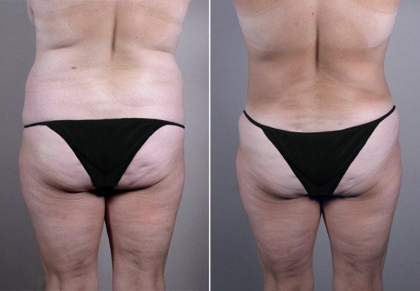 Back view of female patient before and after tummy tuck