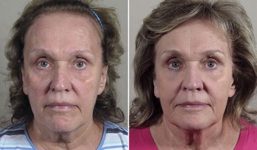 Woman before and after lower eyelid surgery