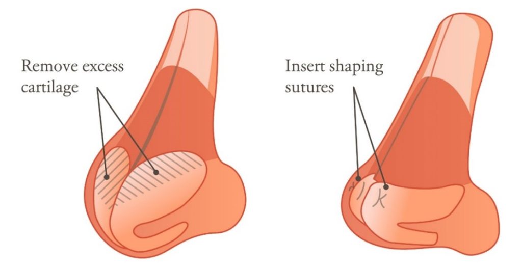 Excess cartilage is removed from the tip of the nose and shaping sutures are inserted