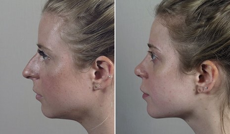Profile of young female before and after rhinoplasty