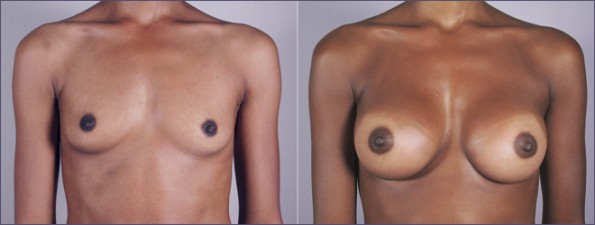 Breast Augmentation Before & After