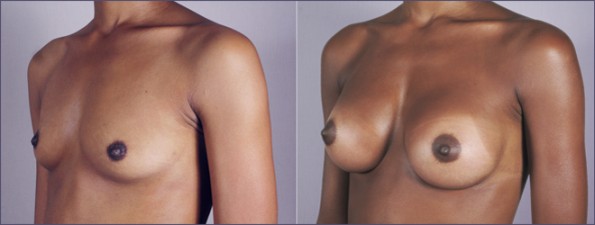 Breast Augmentation Before & After