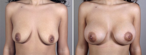 Front view of woman\'s chest before and after breast augmentation