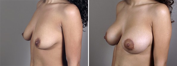 Side view of woman\'s chest before and after breast augmentation