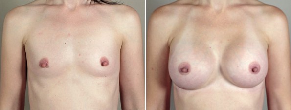 Front view of woman\'s chest before and after breast augmentation