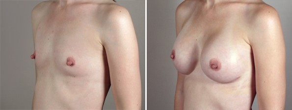 Side view of woman\'s chest before and after breast augmentation