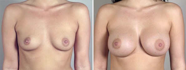 Front view of woman\'s chest before and after breast augmentation