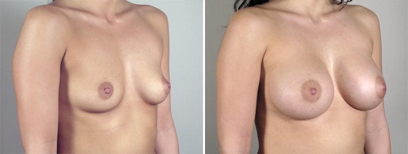 Side view of woman\'s chest before and after breast augmentation