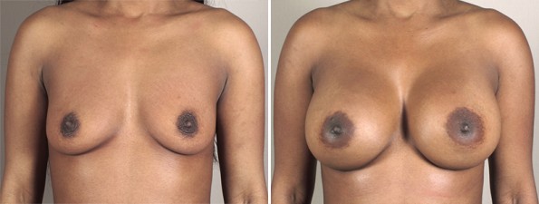 Front view of woman\'s chest before and after breast augmentation