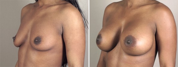 Side view of woman\'s chest before and after breast augmentation