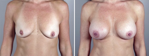 Woman\'s chest before and after breast enlargement