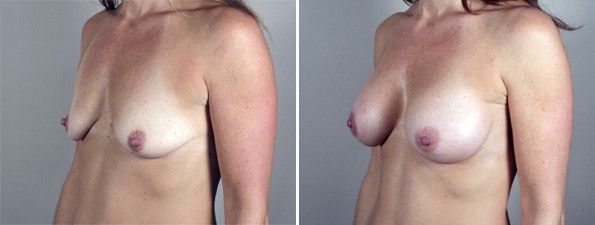 Side view of woman\'s chest before and after breast enlargement