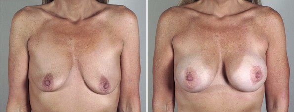 Woman\'s chest before and after breast enlargement