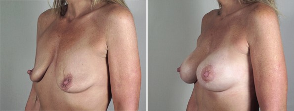 Side view of woman\'s chest before and after breast enlargement