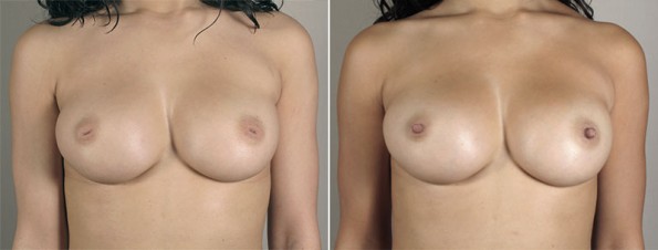 Front view of woman\'s chest before and after inverted nipple correction