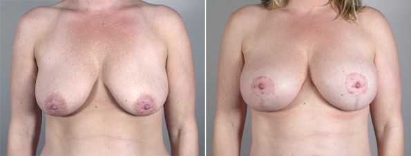 Front view of woman\'s chest before and after breast lift surgery