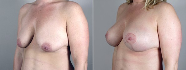 Side view of woman\'s chest before and after breast lift surgery