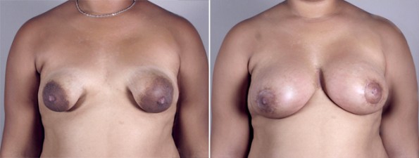 Front view of female patient before and after breast lift