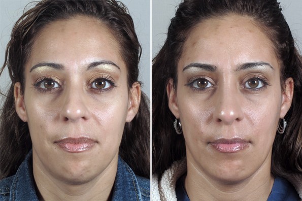 Front view of woman before and after rhinoplasty with chin augmentation