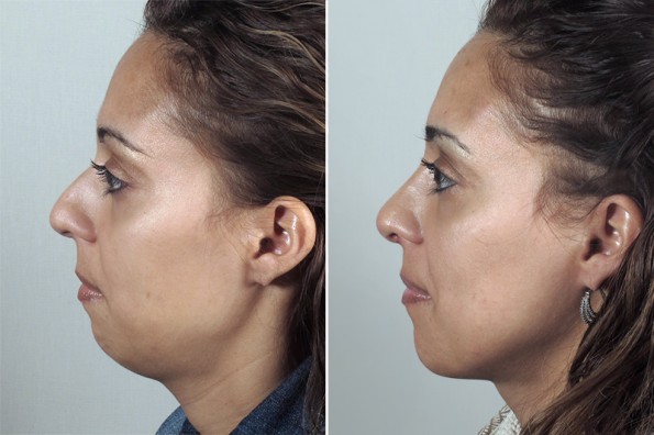 Side view of woman before and after rhinoplasty with chin augmentation