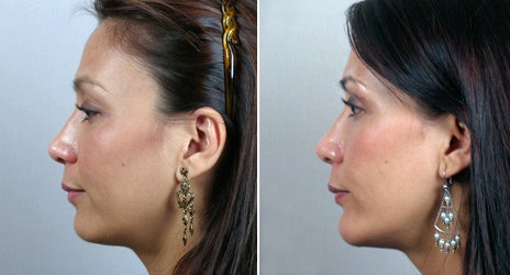 Chin Augmentation New Jersey Before and After