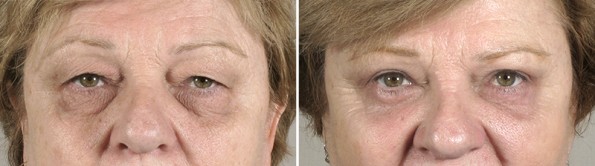Woman before and after upper blepharoplasty