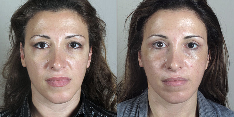 Woman before and after ulbleph with browpexy