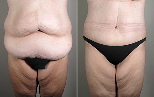 Front view of woman before and after lipoabdominoplasty