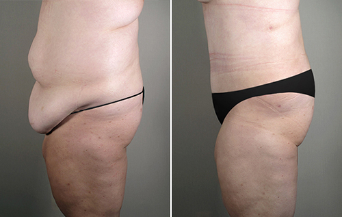 Patient of the Month for March 2011 – The Parker Tummy Tuck