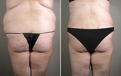 Back view of woman before and after lipoabdominoplasty