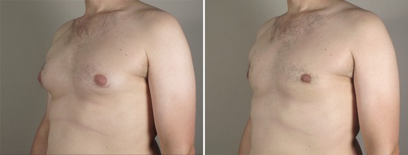 Side view of man\'s chest before and after male breast reduction