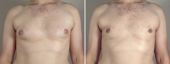 Front view of man\'s chest before and after male breast reduction