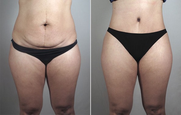 Front view of woman before and after lipoabdominoplasty