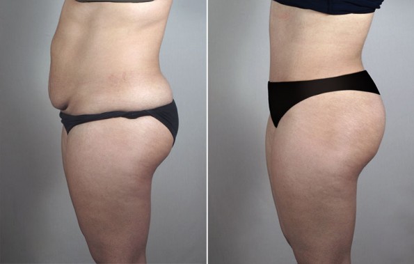 Side view of woman before and after lipoabdominoplasty