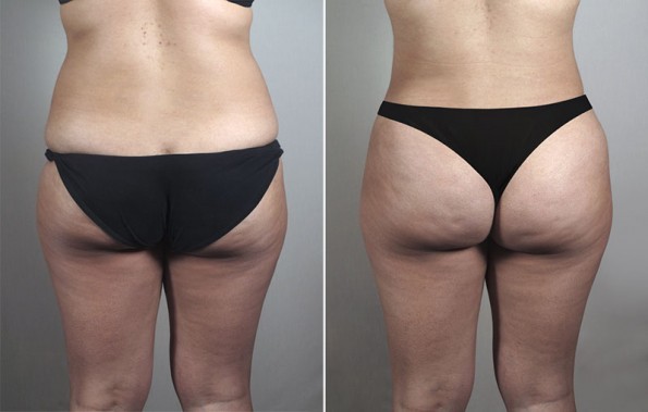 Back view of woman before and after lipoabdominoplasty