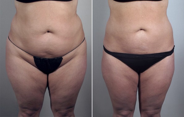 Front view of woman\'s abdomen before and after liposuction