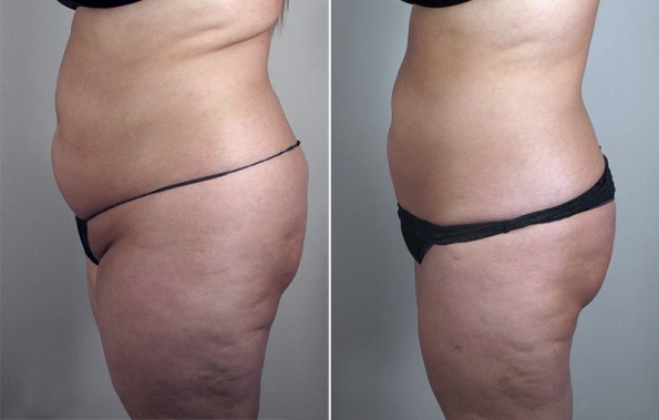 Side view of woman\'s abdomen before and after liposuction