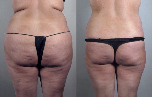Back view of woman\'s abdomen before and after liposuction
