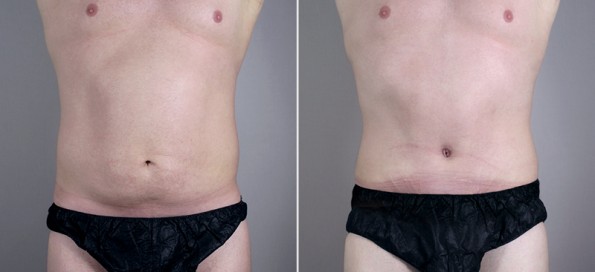 Front view of male patient before and after abdominoplasty